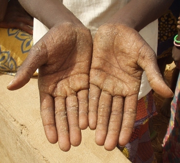 Picture of the hands of someone with Palmar keratosis, Burkina Faso